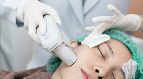 Ultherapy ultrasound skin lifting treatment in Jackson TN - natural face and neck lift